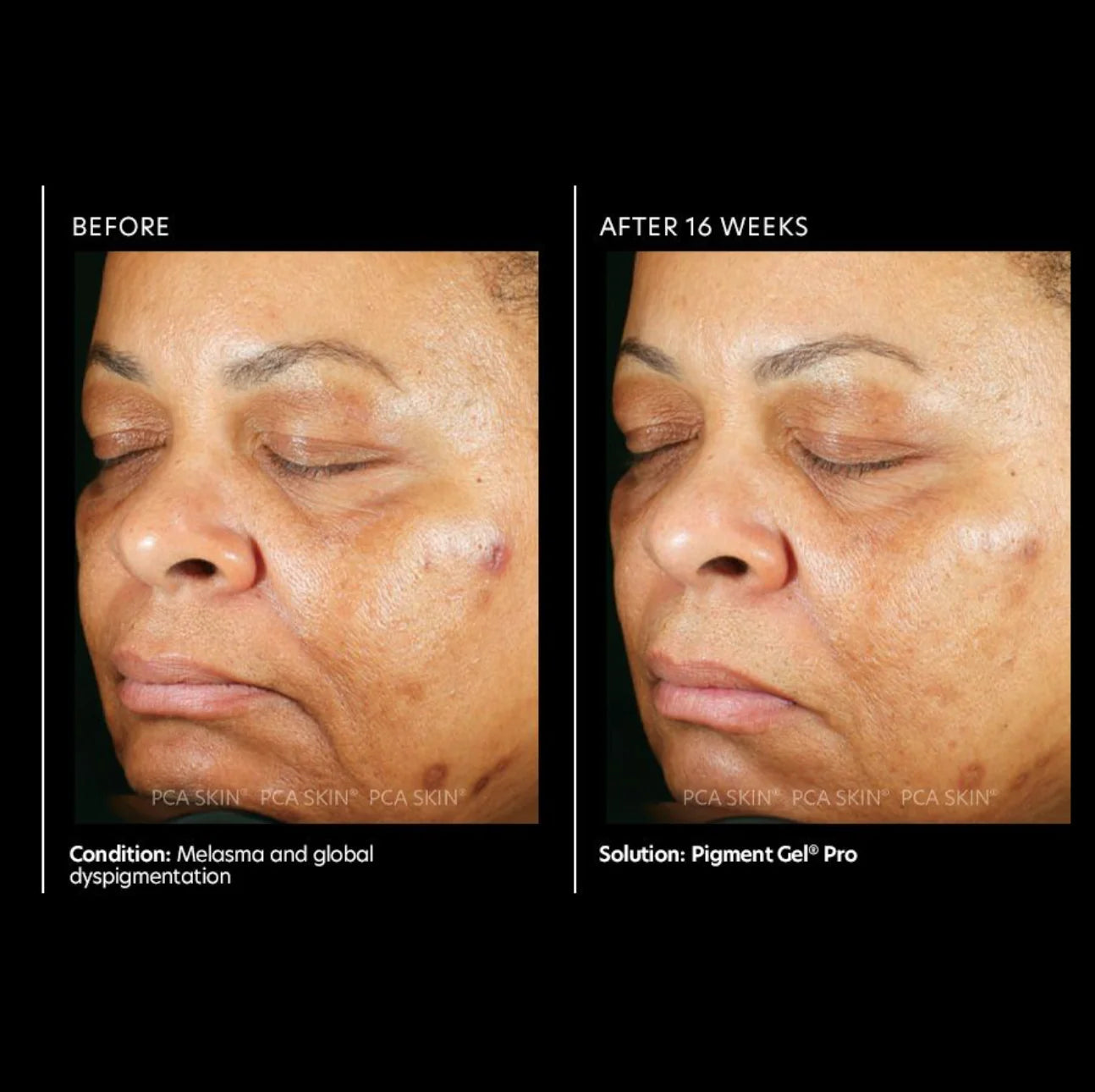 Pigment Gel® Pro